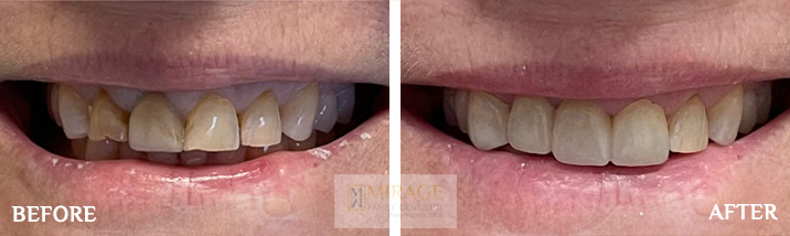 Bridges - Before and After