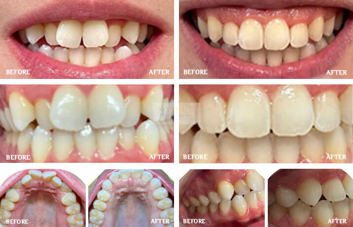 Clear Aligners - Before and After