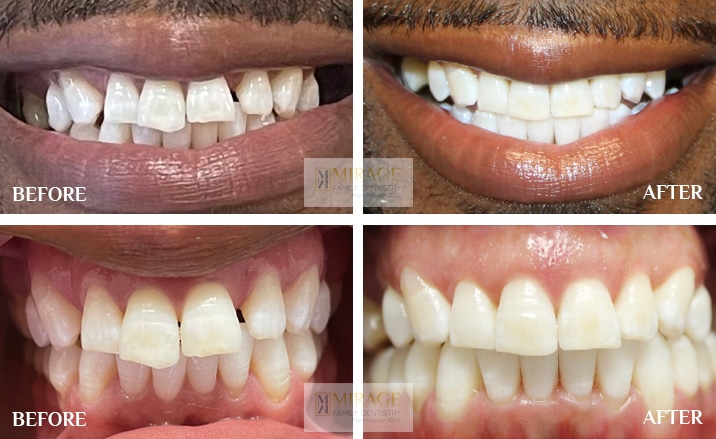 Clear Aligners - Before and After