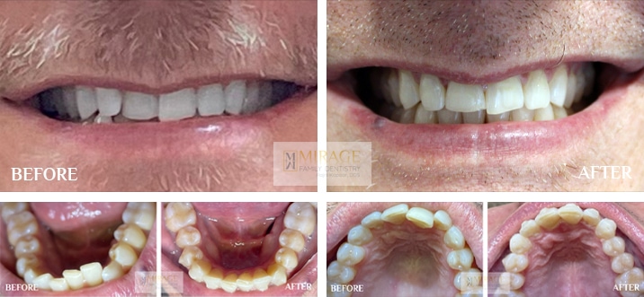 Clear Aligners - Before and After