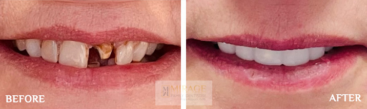 Crowns - Before and After