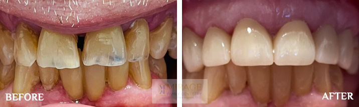 Crowns - Before and After