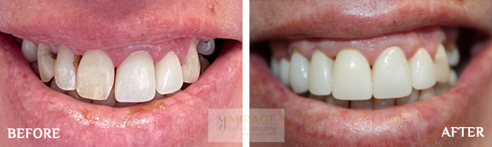 Crowns - Before and After