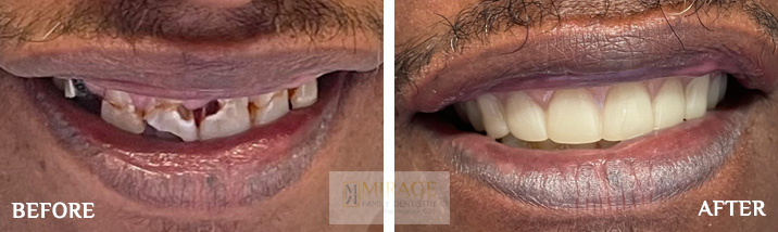 Dentures - Before and After