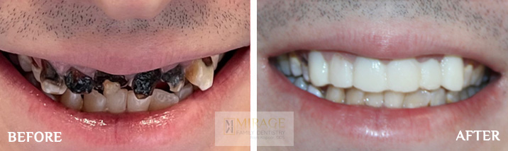 Root Canals - Before and After