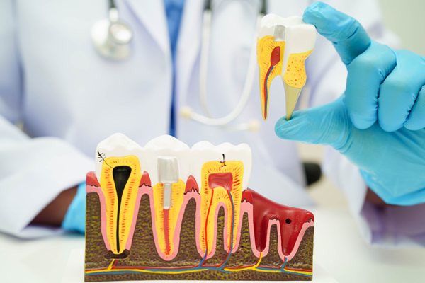 FAQs About Root Canal Treatment
