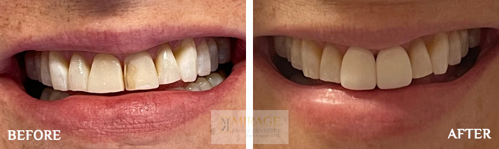 Veneers - Before and After