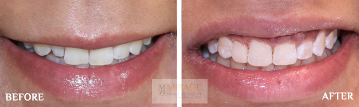 Veneers - Before and After